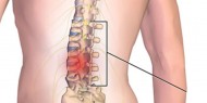الانزلاق الغضروفي.. الأسباب وطرق العلاج